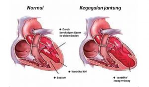 Kolestrol Penyebab Sakit Jantung Yang Kronik.